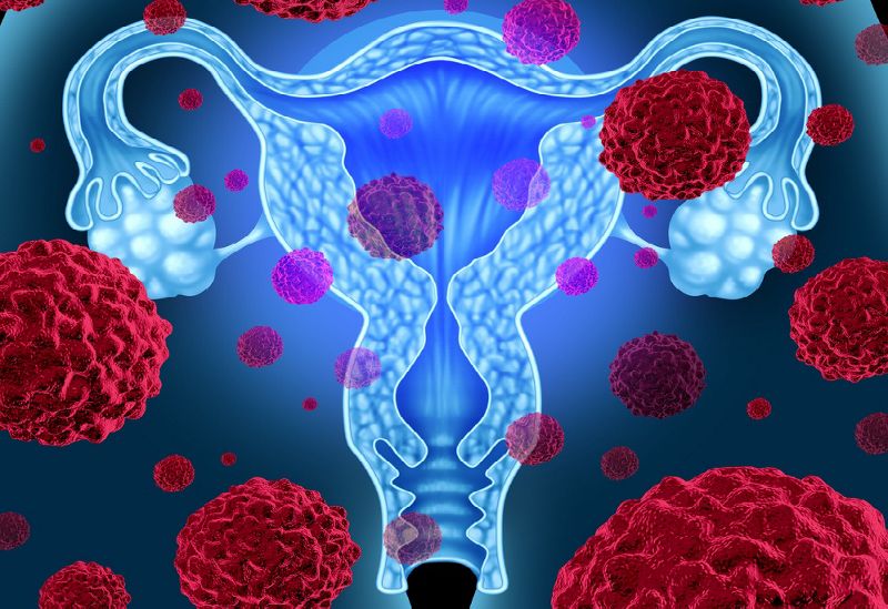 Cancer Du Col Uterin
