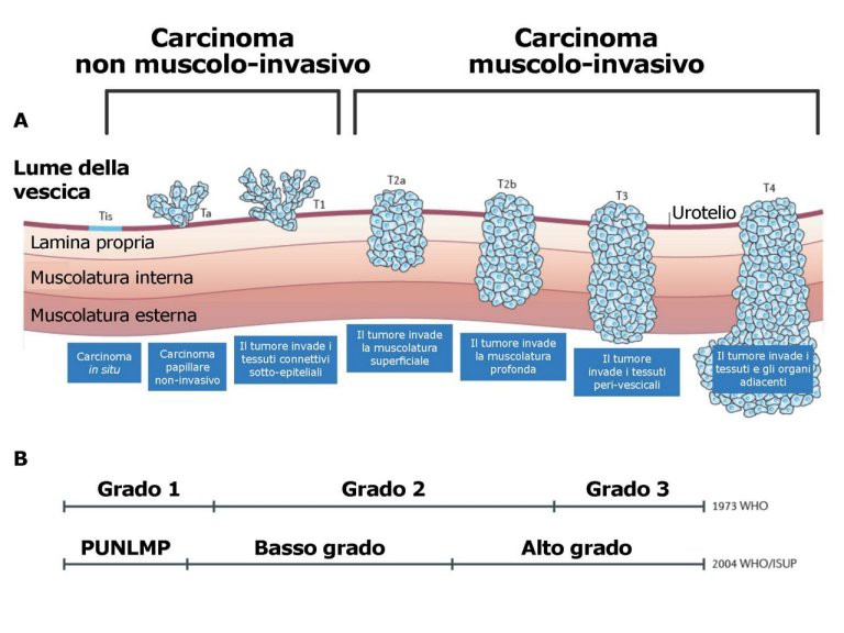 papilloma vescicale sopravvivenza)