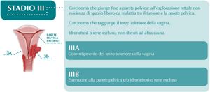 Stadiazione del Carcinoma della Cervice Uterina