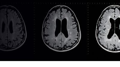 MRI in the diagnosis of multiple sclerosis. MCSC patient's history