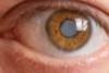ojo con cataratas