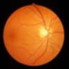 ojo con drusas de tamaño medio en la macula