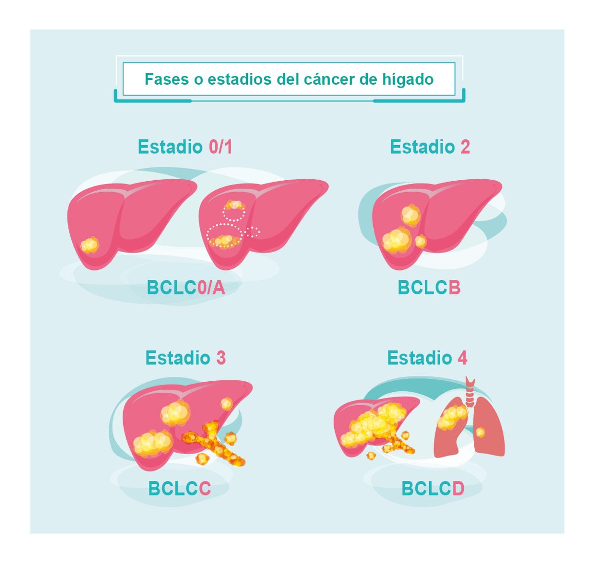 Fases o estadios del cáncer de hígado | Roche Pacientes